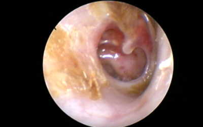 From Need for Hearing Aids to Almost Normal Hearing