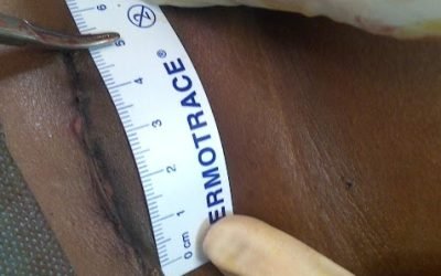 My Typical Thyroid Incision – Nationally & Internationally