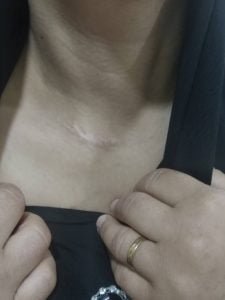 My Typical Thyroid Incision - Nationally & Internationally 2 Mini 2BThyroid 2BIncision
