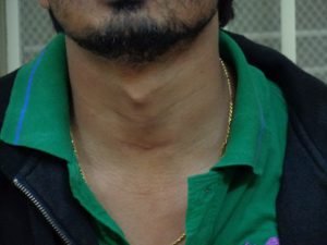 My Typical Thyroid Incision - Nationally & Internationally 3 Scarless 2BThyroid 2BSurgeon