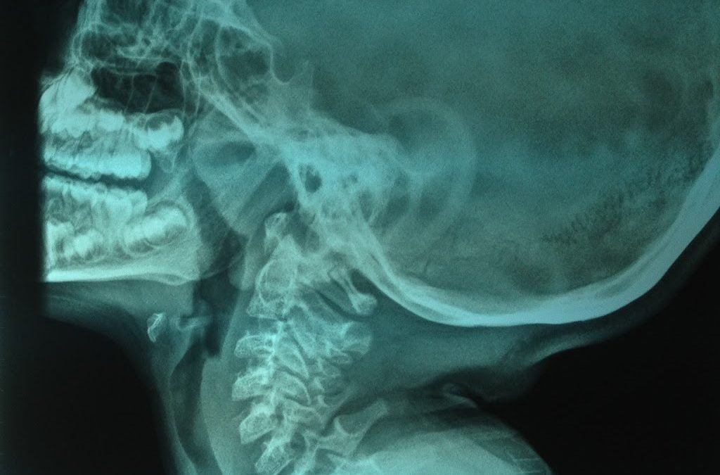 ADHD or just Adenoidal Swelling?