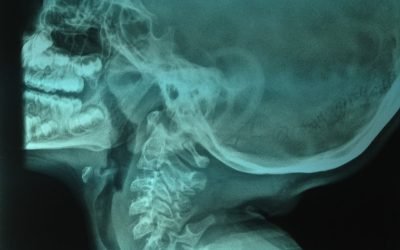 ADHD or just Adenoidal Swelling?