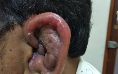 Perichondritis – Cauliflower ear – Cotton Ear Bud Damage