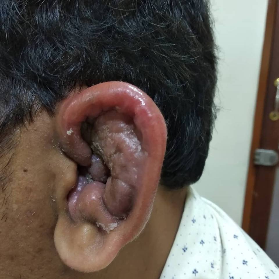 Perichondritis perichondritis