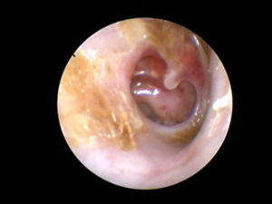 ear drum perforation