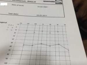 conductive hearing loss