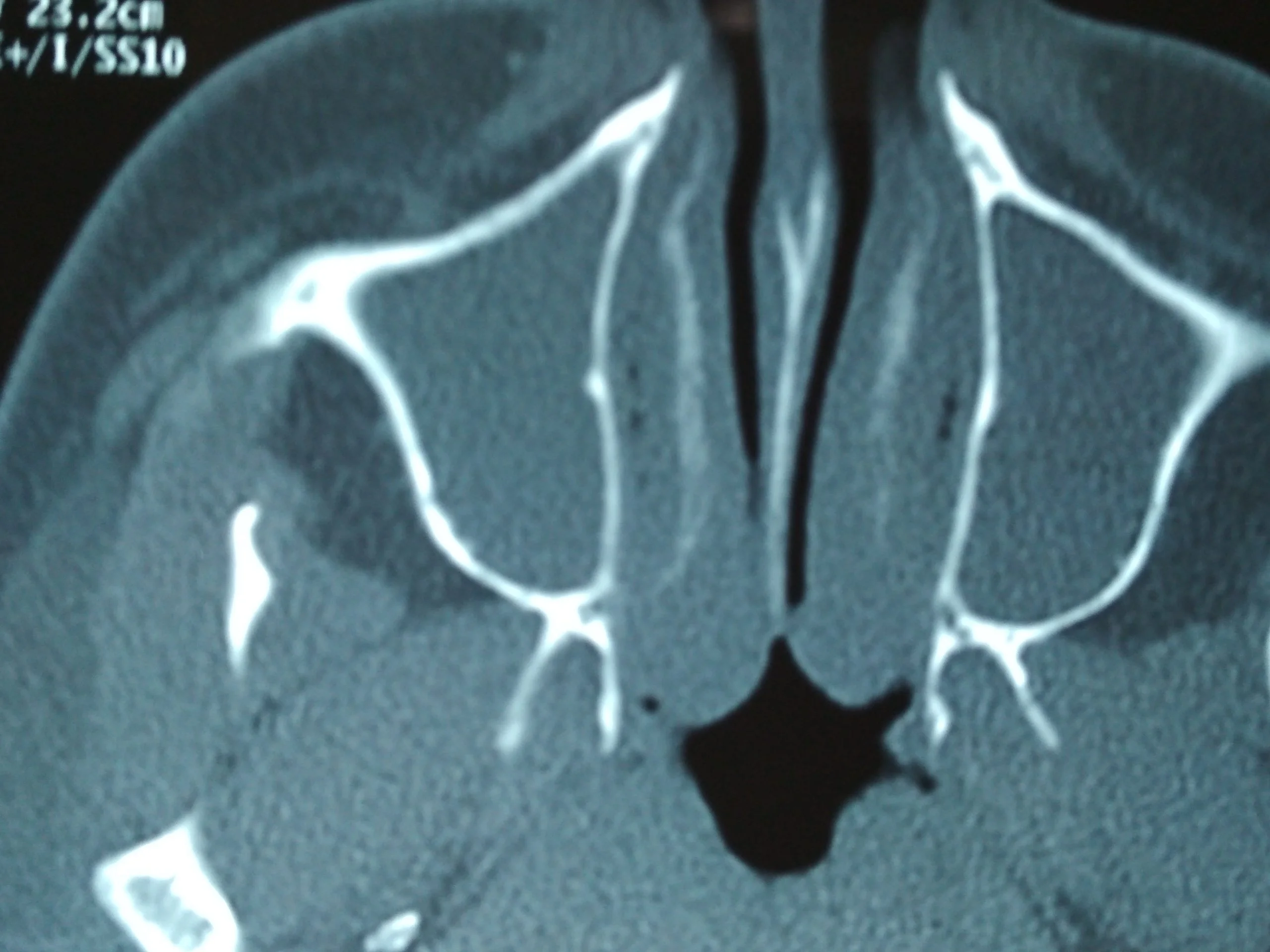 turbinate hypertrophy