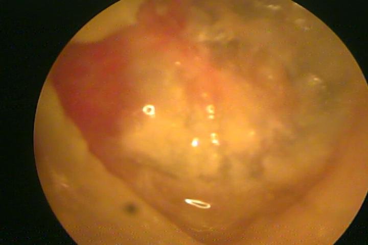 otomycosis