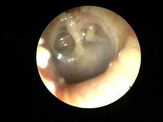 eustachian tube dysfunction