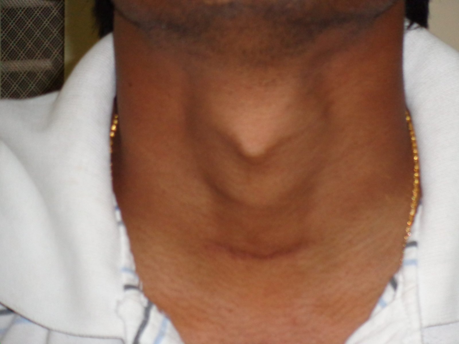 thyroid