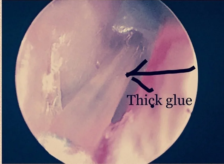 what causes glue ear