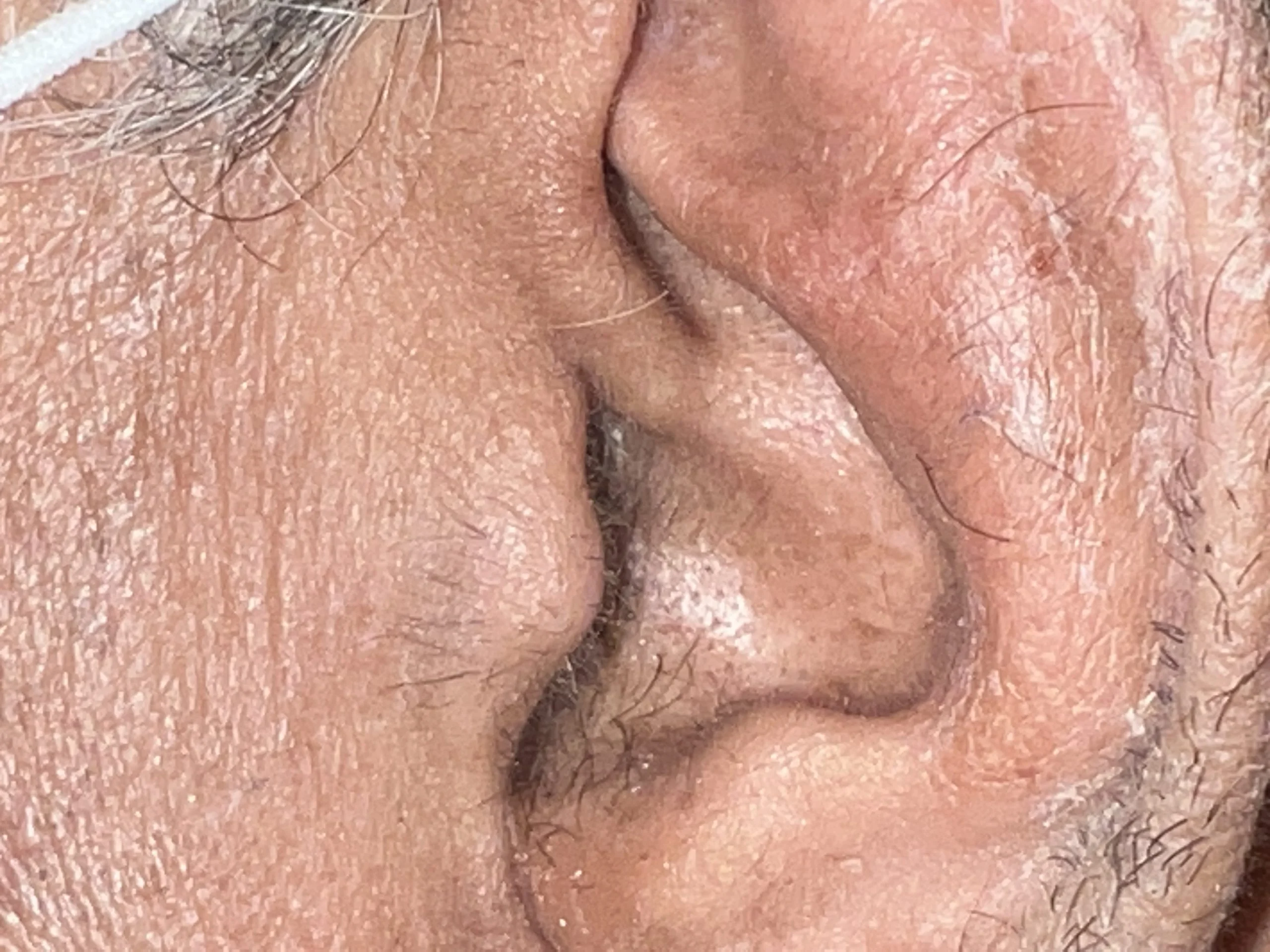 white skin flakes itch