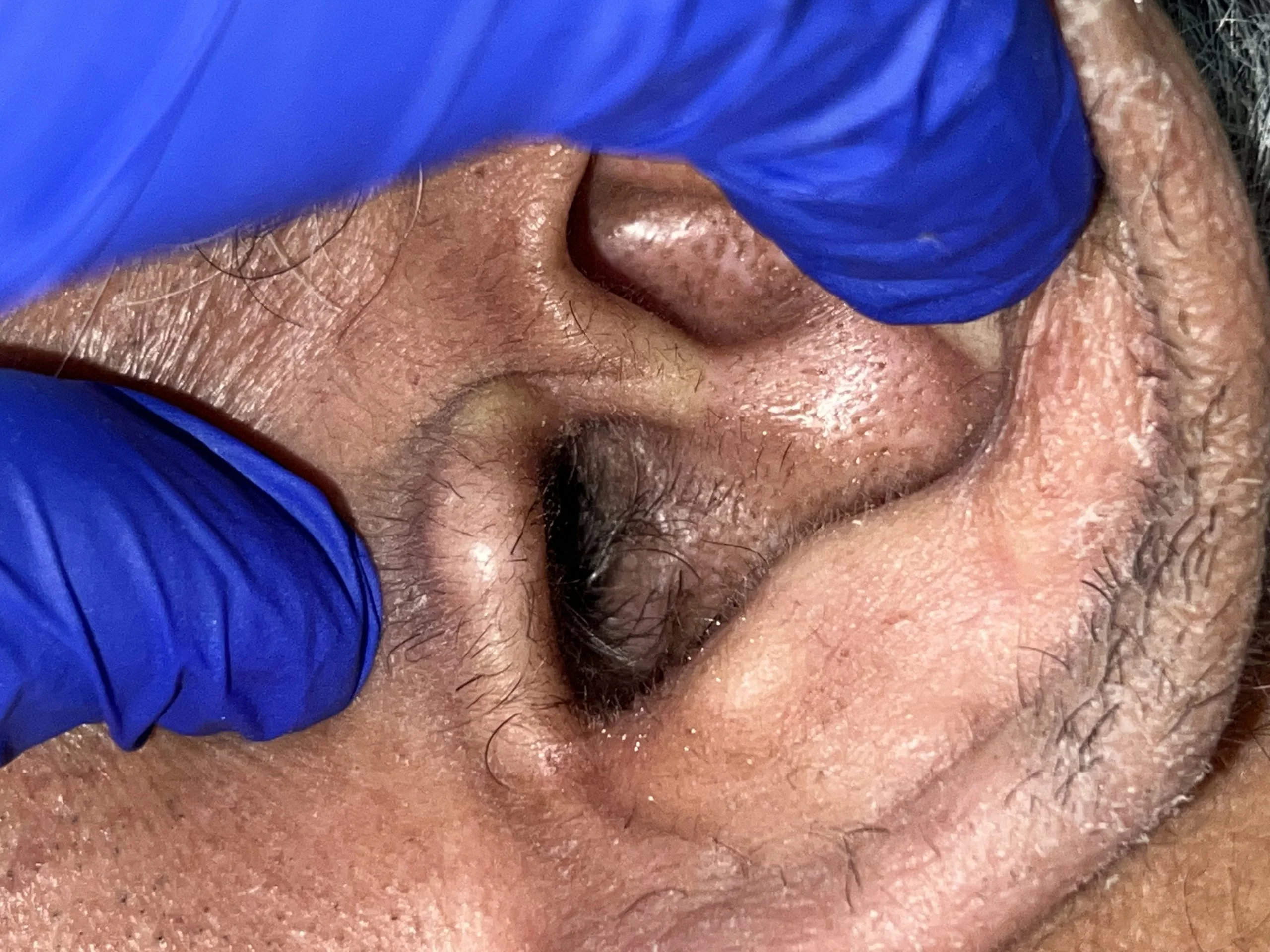 ear buds ear wax inside ear canal