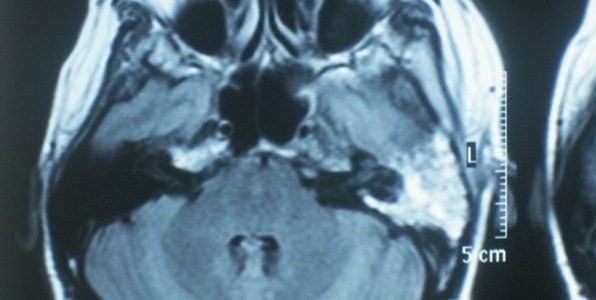 Skull Base Osteomyelitis: When to See a Doctor