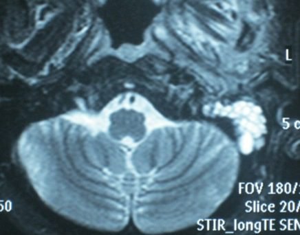 Skull Base Osteomyelitis: Complications