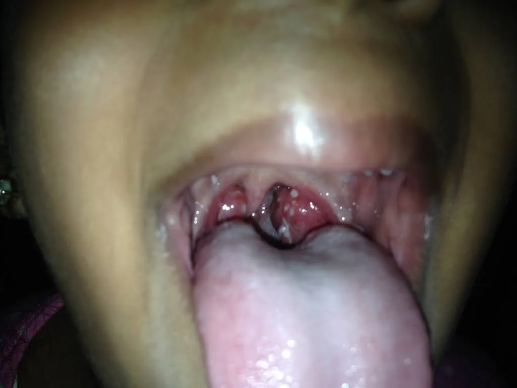 Follicular Tonsillitis tonsillectomy
