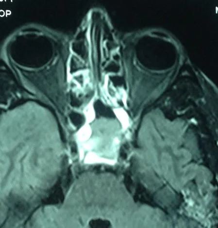fungal sinusitis sinus headache