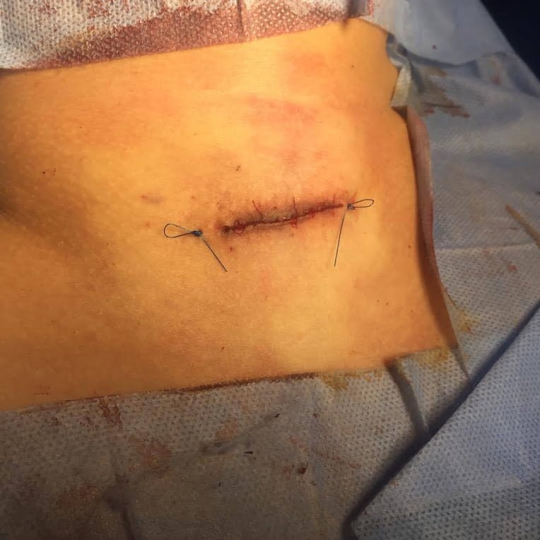 mini-incision