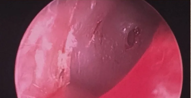 what is myringotomy, is it safe