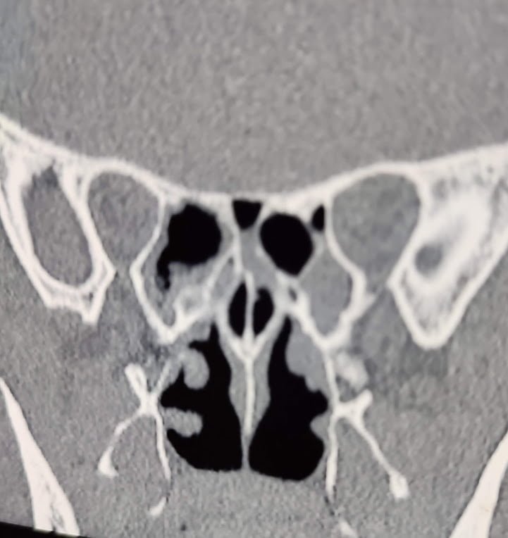 nasal sinusitis