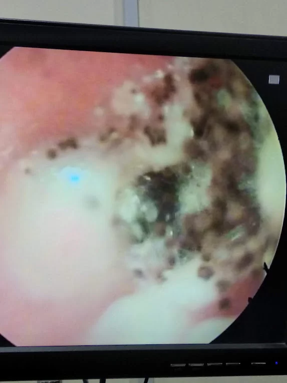 Otomycosis causing ear itching and pain otomycosis