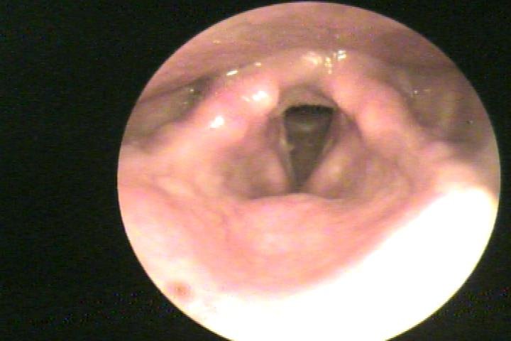 olyp-about.jpg dry cough due to GERD