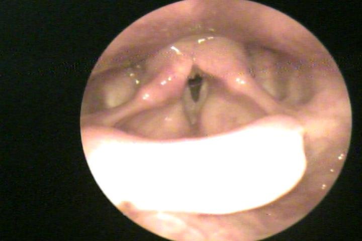 hoarseness
