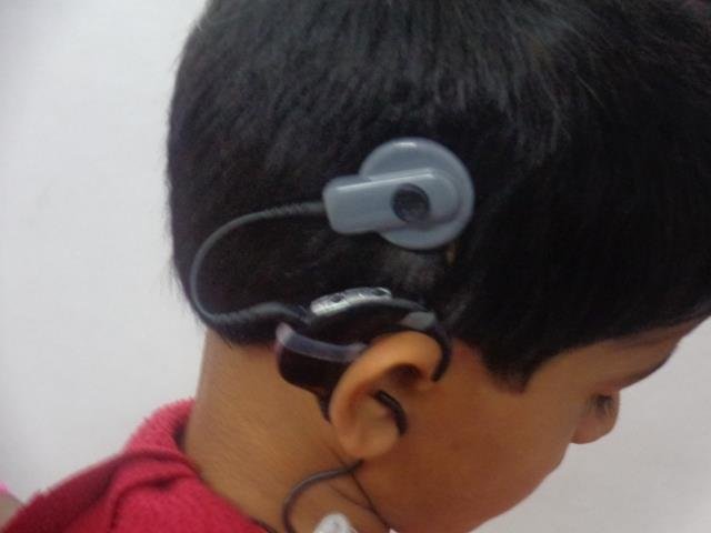 cochlear implant