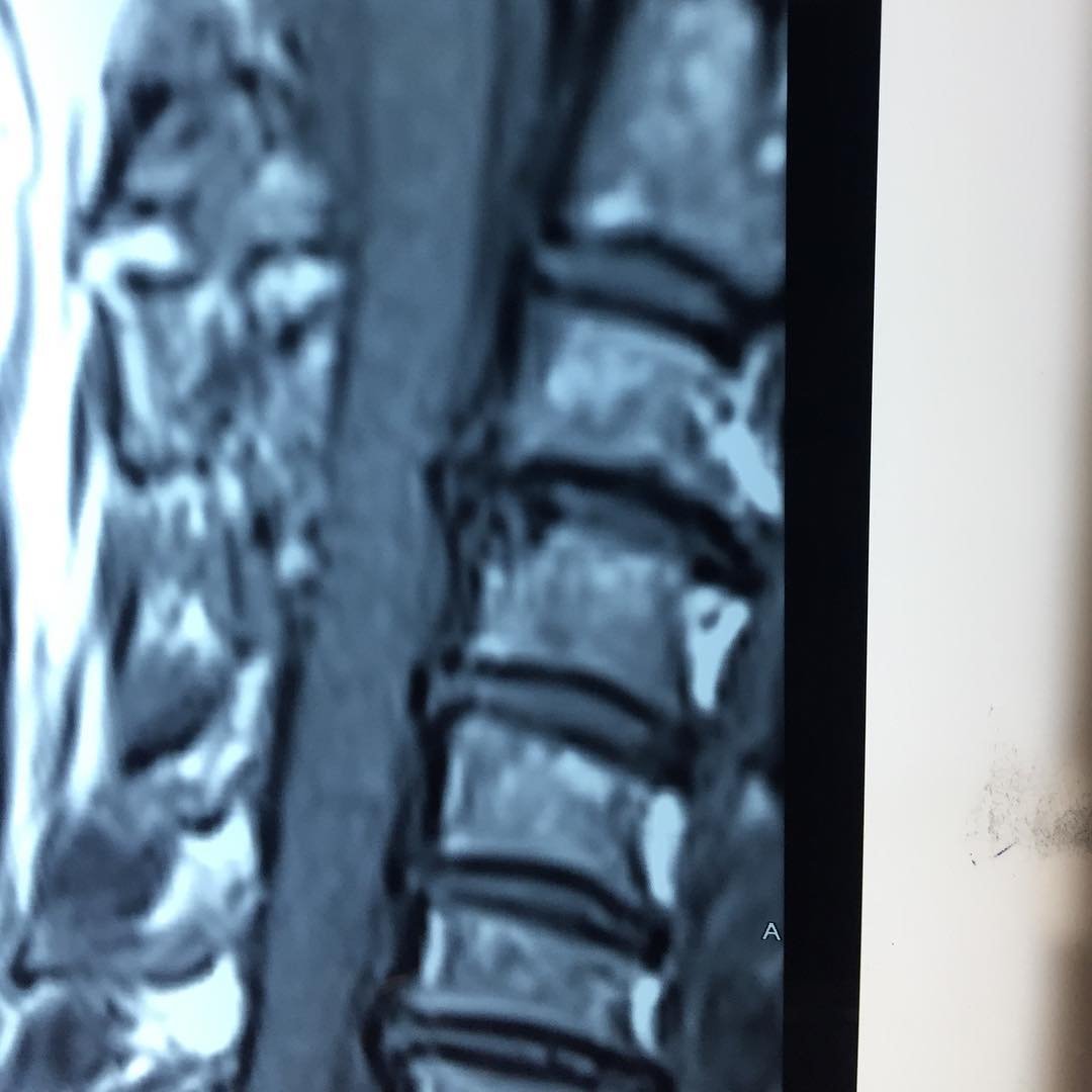 cervical vertigo, neurotologist, drkumaresh cervical vertigo