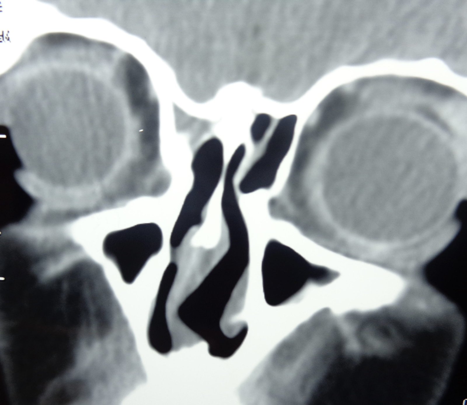 deviated nasal septum