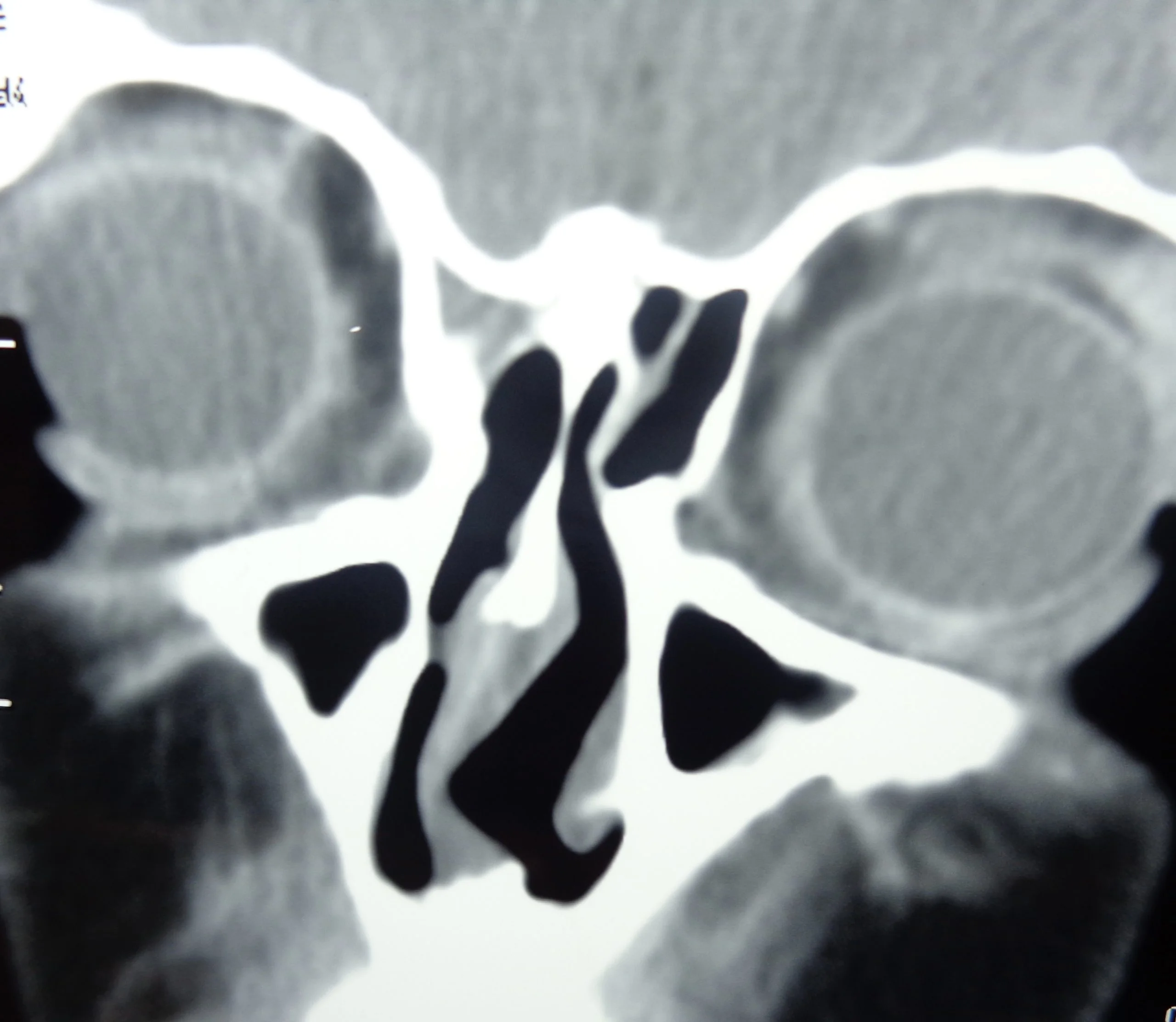 deviated nasal septum, best ent deviated nasal septum