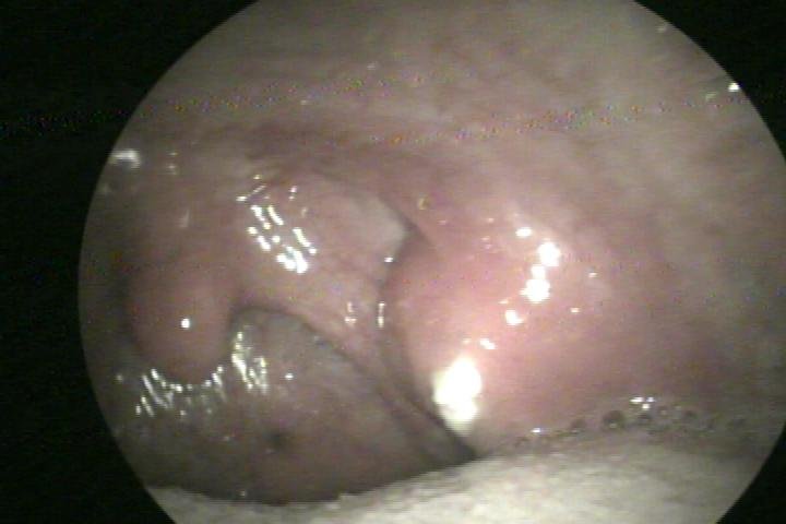 tonsil stone