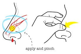 how to stop nose bleeding nosebleed