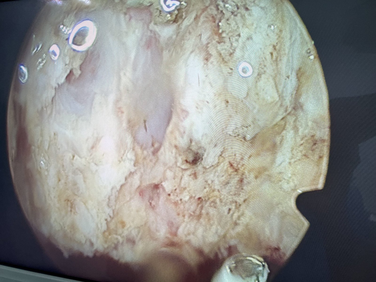 Adenoidectomy adenoidectomy