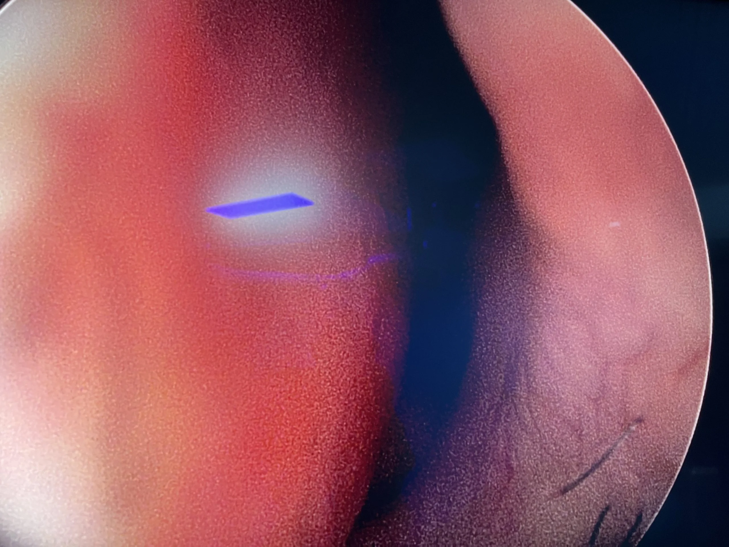 septoplasty with turbinoplasty