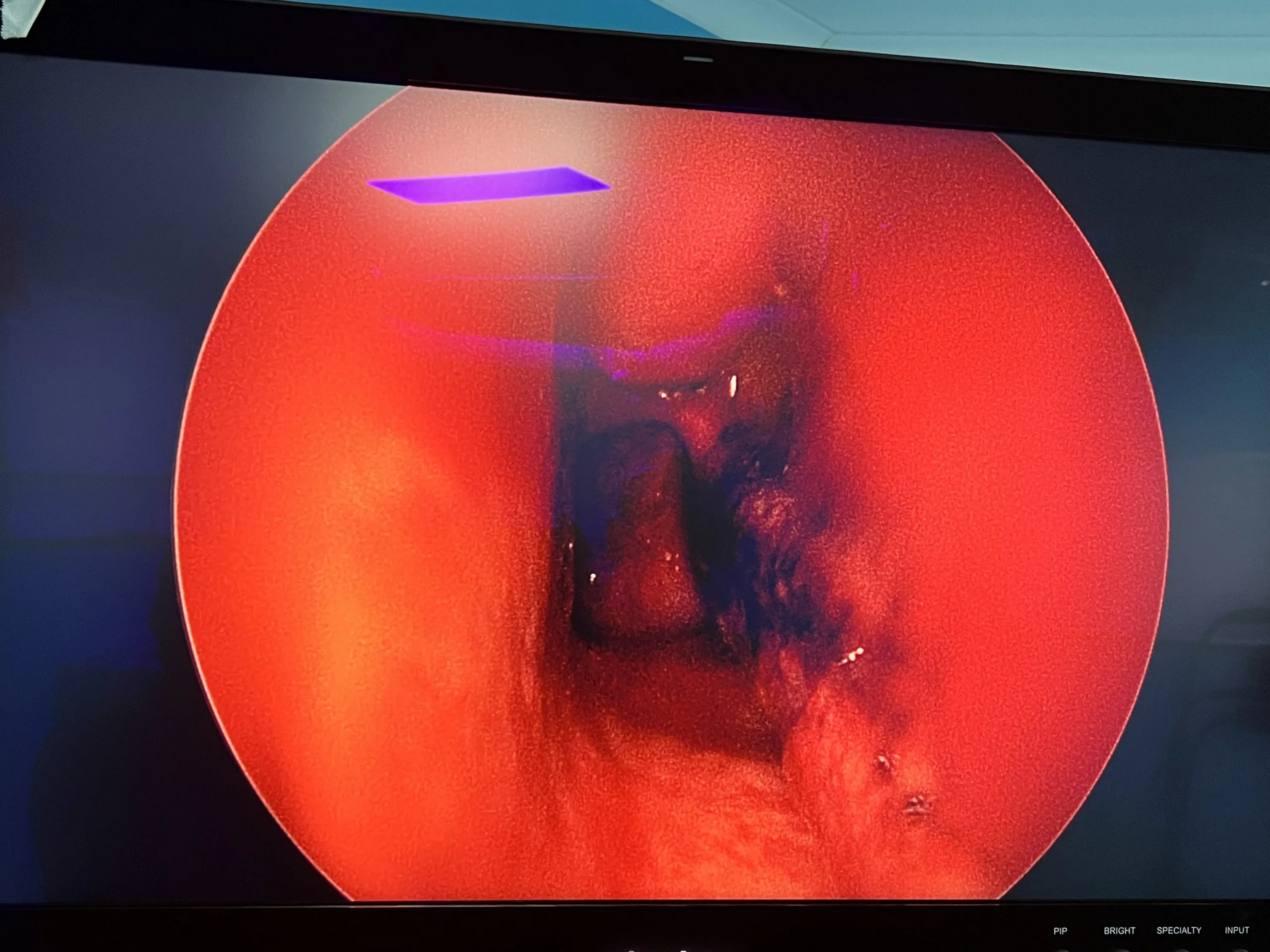 septoplasty with turbinoplasty, 2 testimonials
