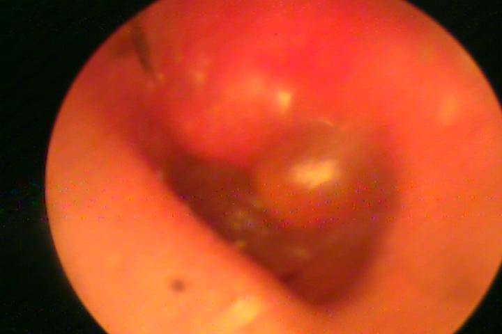 Myringitis Bullosa