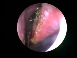 dry nose