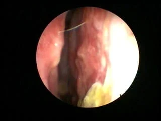 nasal spray overuse