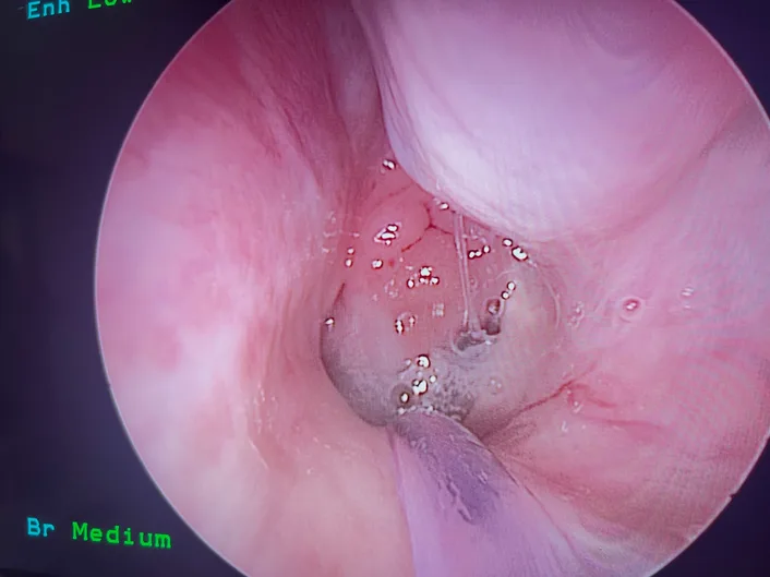 Adenoid, ent near me, pediatric ent failure to thrive