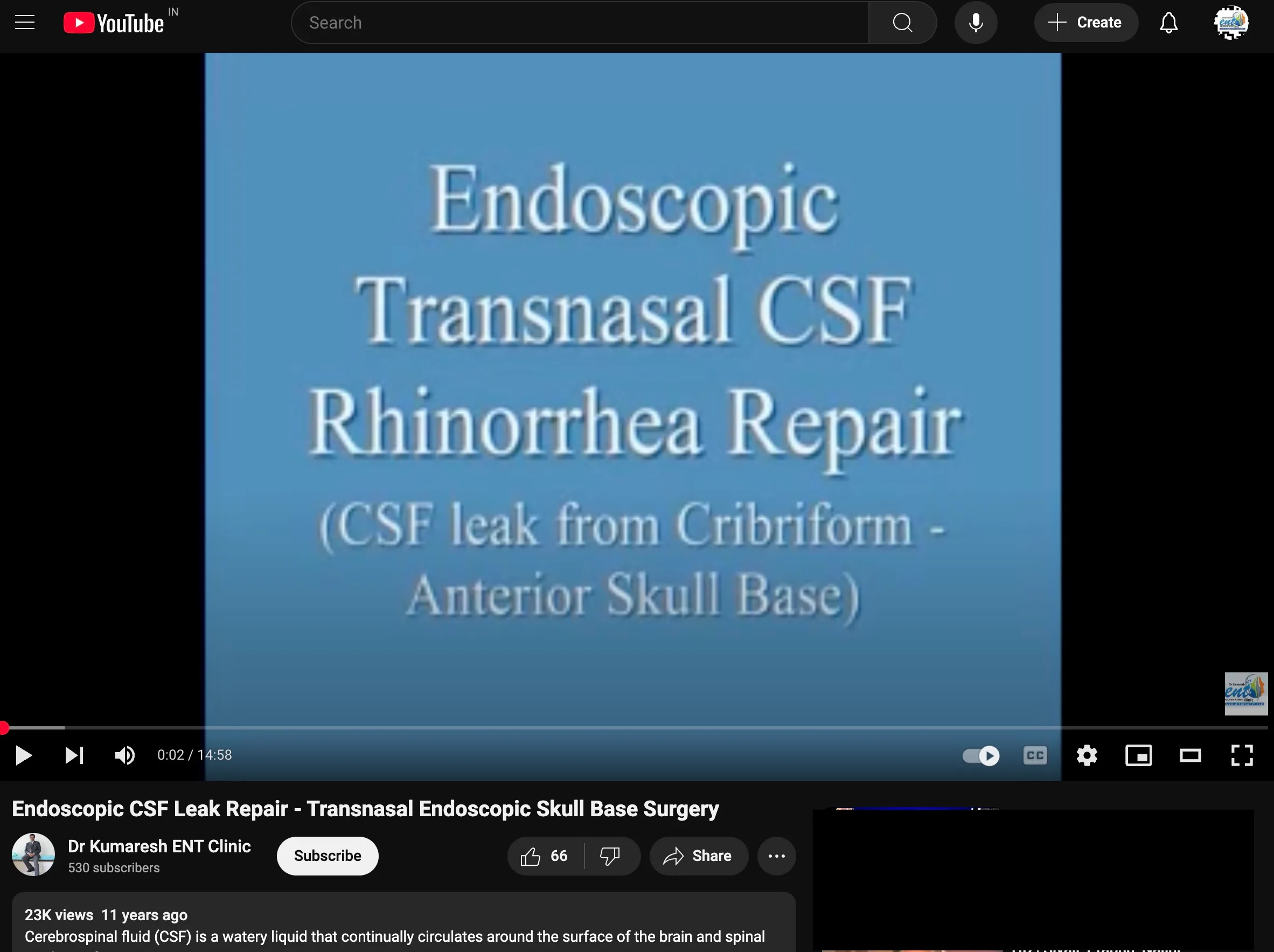 csf leak, cerebrospinal leak, drkumaresh