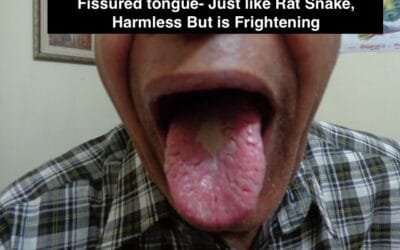 Understanding Fissured Tongue