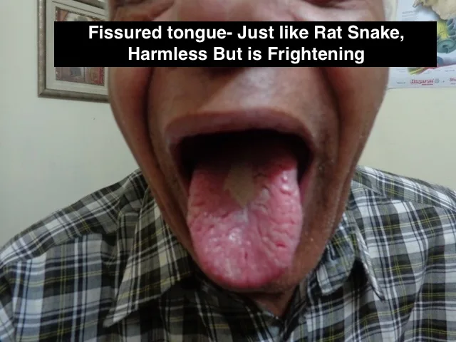 fissured tongue