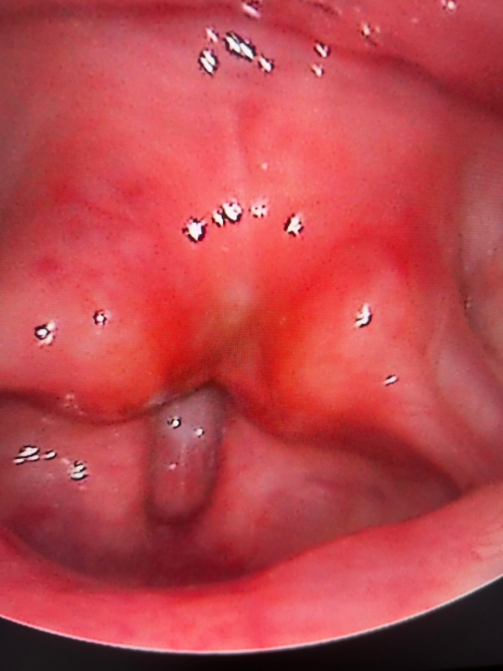 acid reflux, snoring