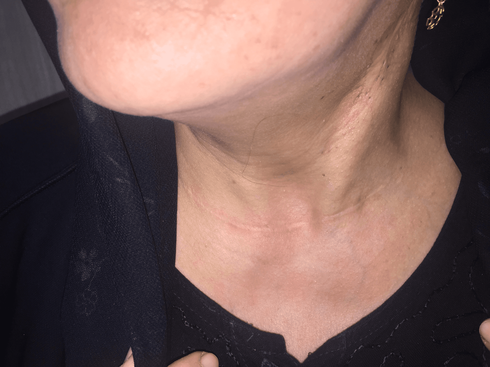 post op photo