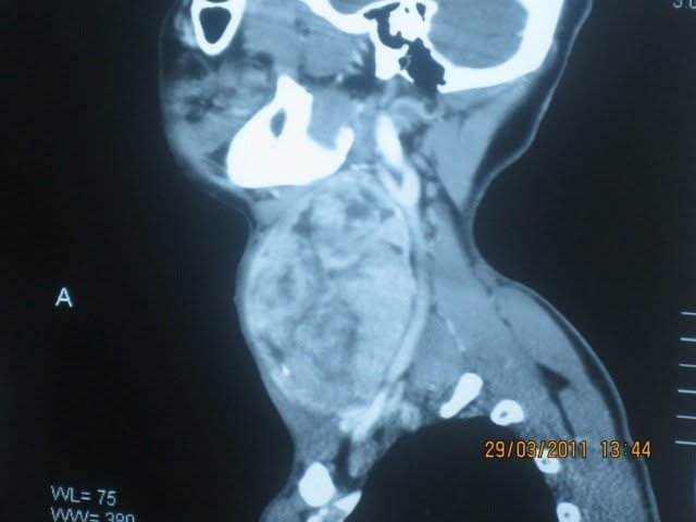 revision thyroid surgery