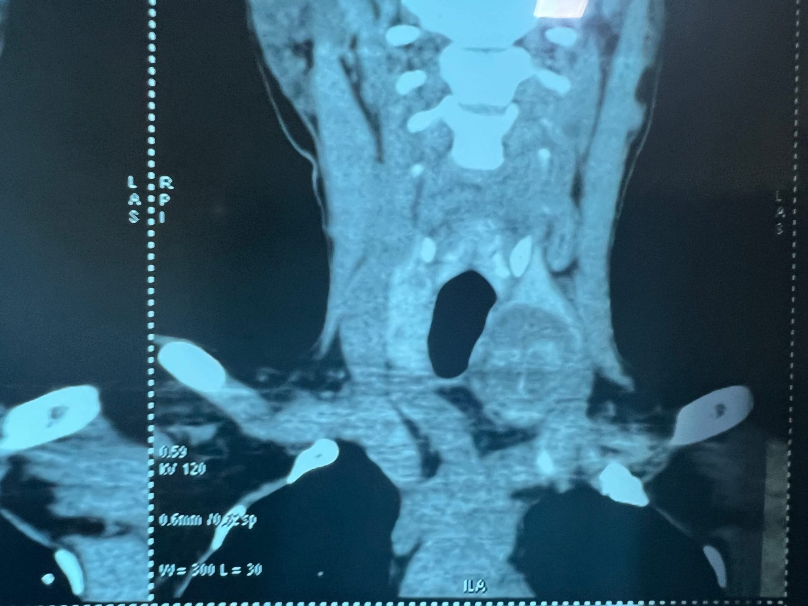 Thyroid Cancer thyroid cancer