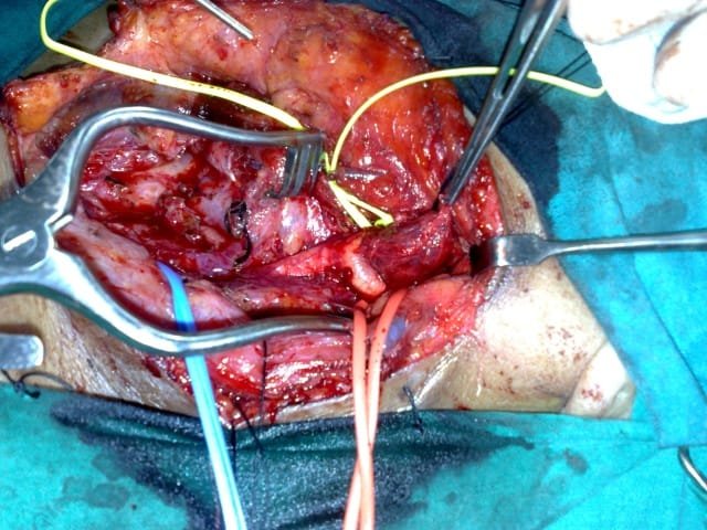 carotid body tumour