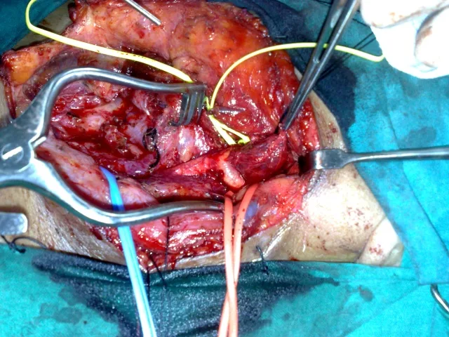 carotid body tumour
