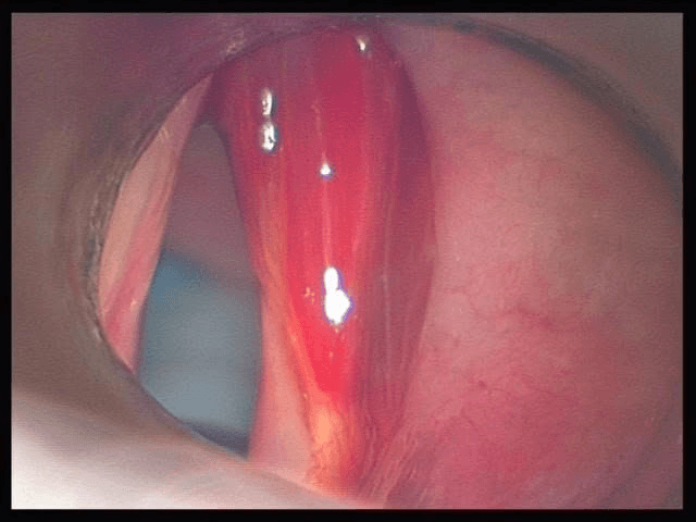 haemorrhagic vocal cord polyp 